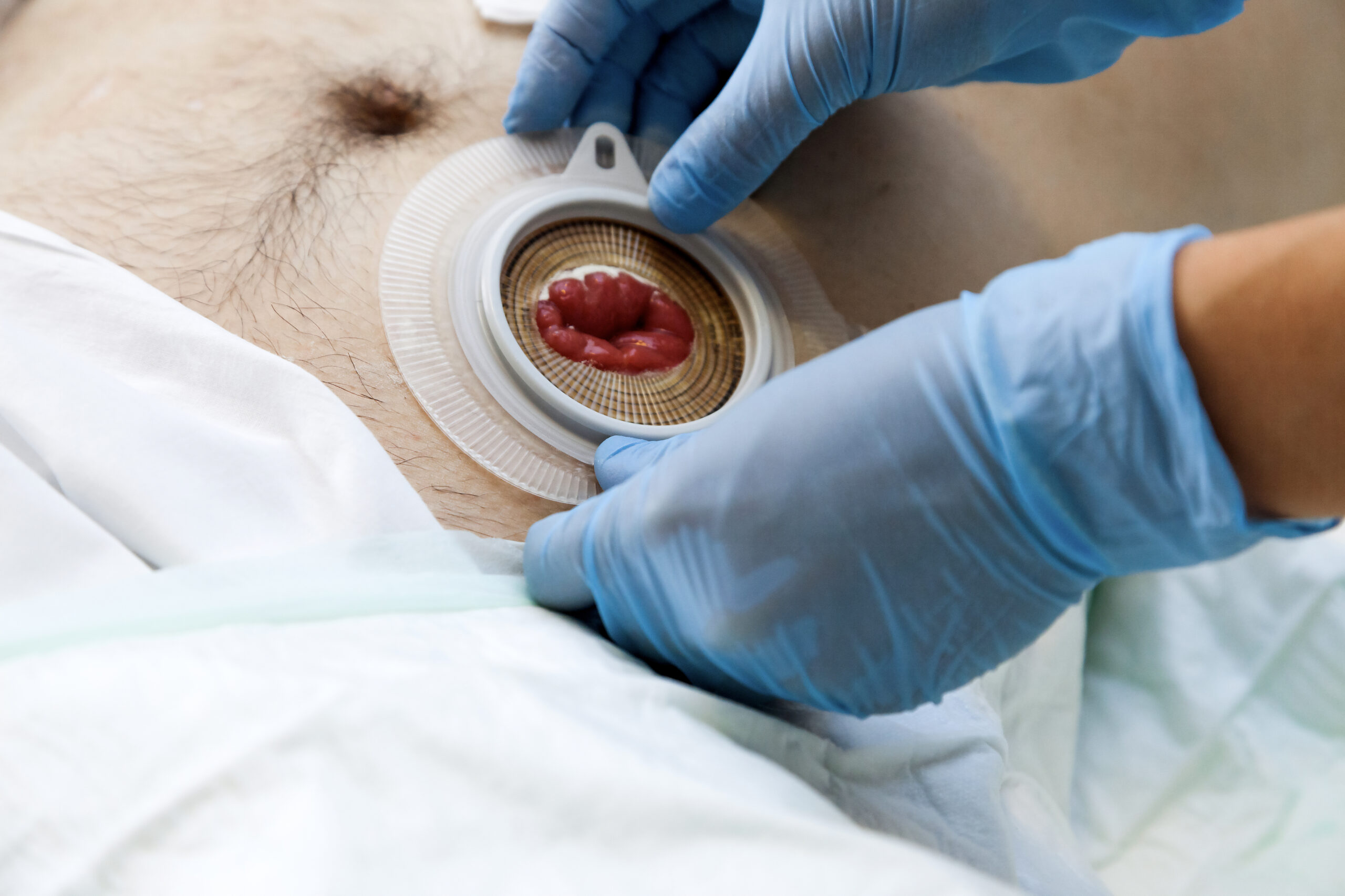 close up stoma and colostomy after colon cancer surgery out. cover stoma with one piece colostomy bag sticking, stoma patient care